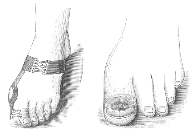 Schwarze und weiße Zeichnung eines Paares Füße, eines mit bandagierter Fraktur und eines mit sichtbarer Fraktur.