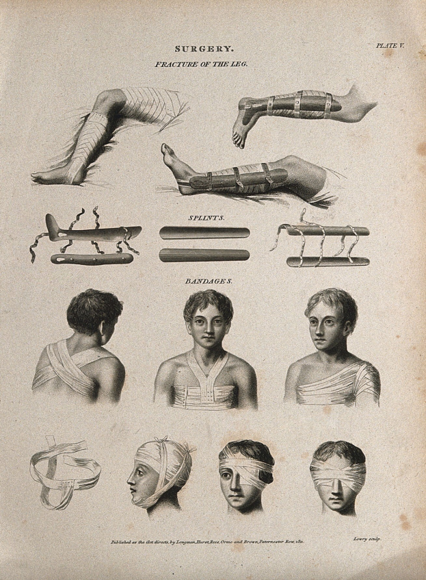 Ein medizinisches Illustration aus dem 19. Jahrhundert, das die Beine eines Mannes und den Kopf einer Frau zeigt, beide mit bandagierten Köpfen, begleitet von beschreibendem Text.